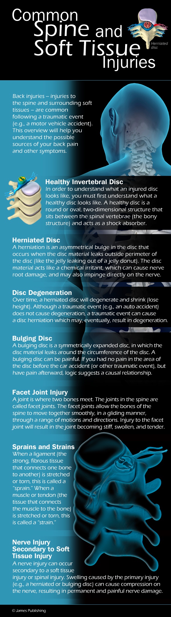 Spine and Soft Tissue Injuries personal injury lawyer in Vancouver